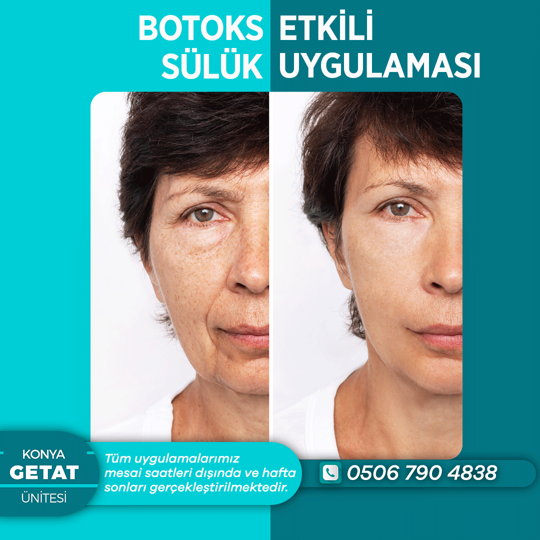 Botoks Etkili Sülük Uygulaması